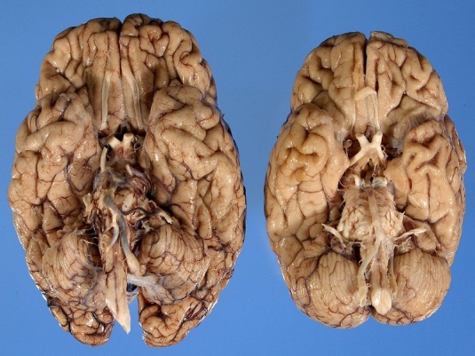 brain-autopsy