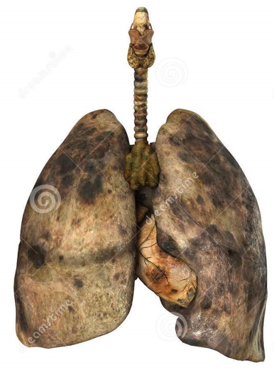 healthy-diseased-human-lungs-48362331